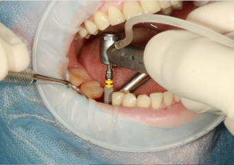 a dental implant procedure